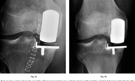 Unicompartmental Arthroplasty with the Oxford Knee Oxford Medical Publications Reader