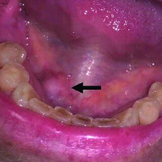 Unilateral swelling of the mouth: