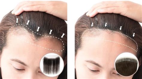 Uniwigs Hair Patches: The Ultimate Guide to Restoring Your Hairline with Confidence