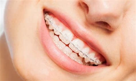 Unlocking a Brighter Smile: A Comprehensive Guide to Braces Student Price in Singapore