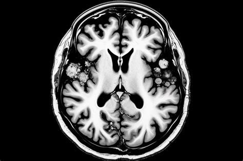 Unraveling the Enigma of Railey Disease: A Comprehensive Guide to Diagnosis, Treatment, and Hope