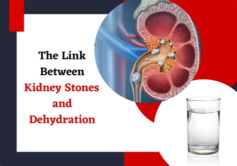 Unraveling the Link Between Zyn and Kidney Stones