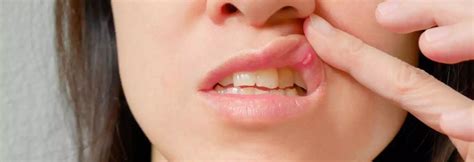 Unveiling the Truths Behind Canker Sore from Zyn: A Comprehensive Guide