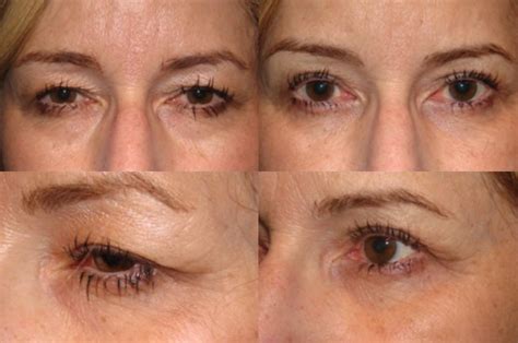 Upper Blepharoplasty: