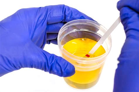 Urinalysis: