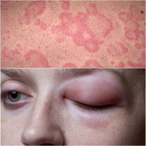 Urticaria and Angioedema Doc