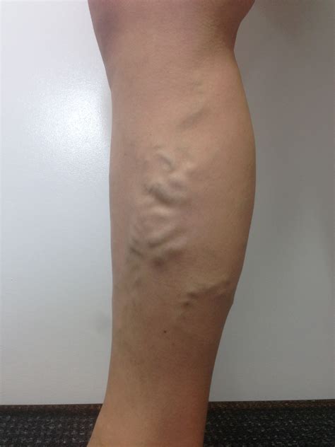 Varicose Veins Reader