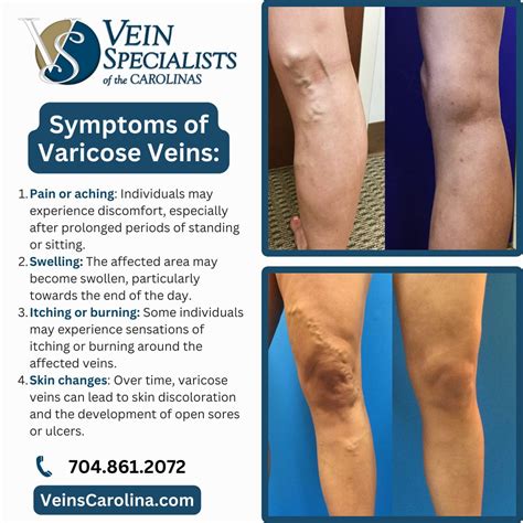 Varicose Veins: A Common Problem