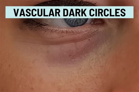 Vascular Dark Circles: