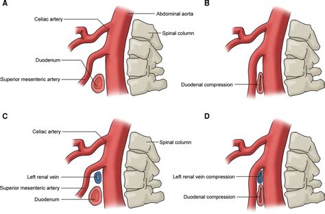 Vascular compression: