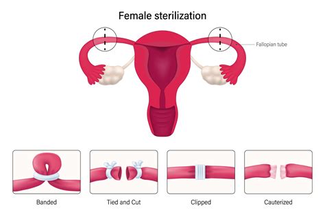 Vasectomy vs Tubal: The Ultimate Guide to Permanent Birth Control