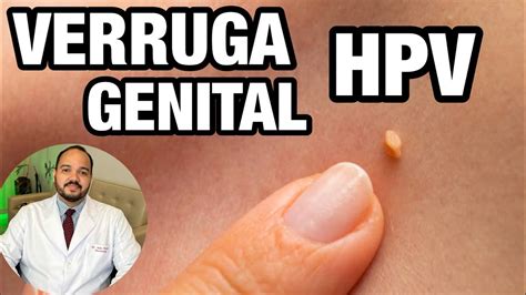 Veja Como Tratar Verrugas de HPV: Fotos e Dicas Poderosas