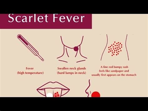 Velvet Scarlatina: A Comprehensive Guide to Symptoms, Treatment, and Prevention