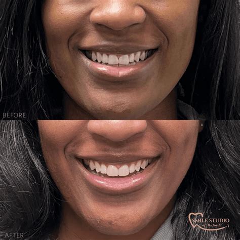 Veneers Before and After: A Comprehensive Guide to a Brighter Smile