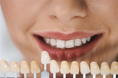 Veneers Singapore Price: What You Need to Know