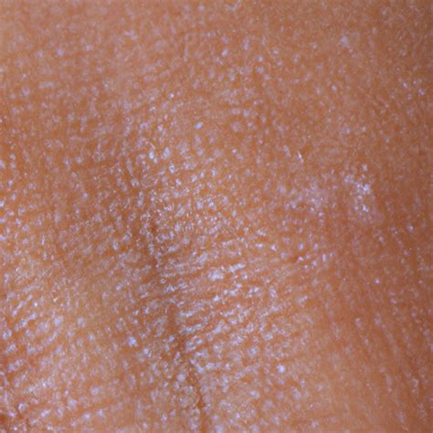 Venus Cuellar: The Ultimate Guide to Diagnosing and Treating This Rare Skin Condition