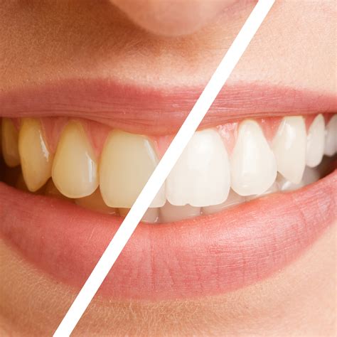 Vividwhit: Redefining the Future of Teeth Whitening for a Brighter, Confident Smile