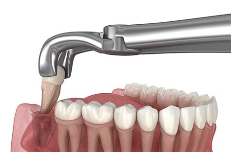 Você pode usar Zyn após a extração do dente do siso?