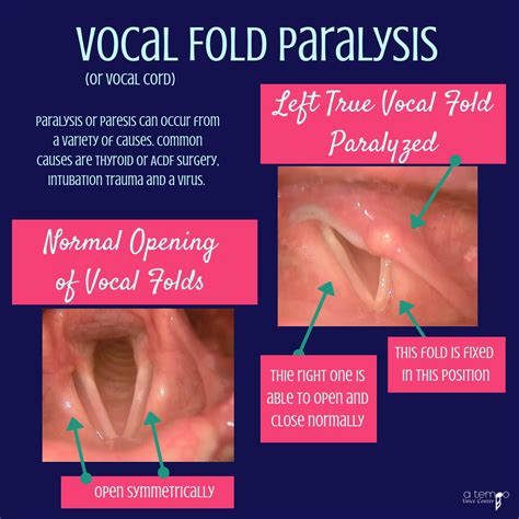 Vocal Fold Paralysis Reprint Epub