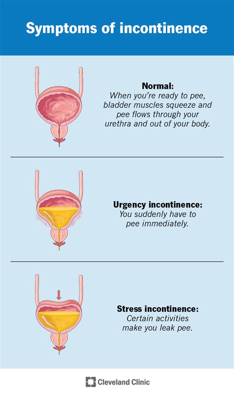 Wet With Nickiii: Unveiling the Benefits and Challenges of Urinary Incontinence Treatment