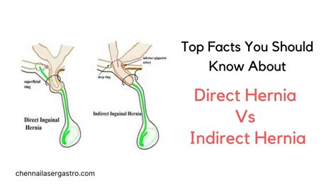 What's the Scoop on Hernias?