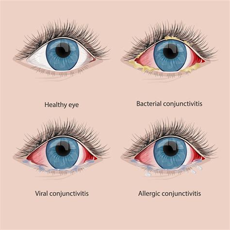 What is Conjunctivitis?