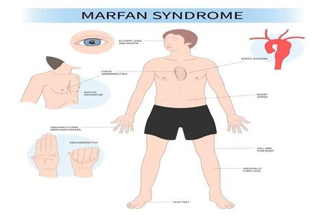 What is Fan Syndrome?