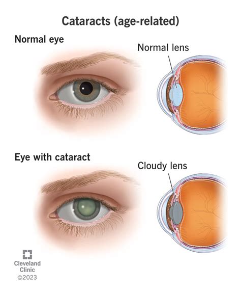 What is a Cataract?