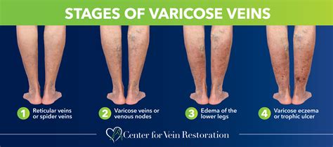 When to Worry: A Guide to Identifying Severe Varicose Veins