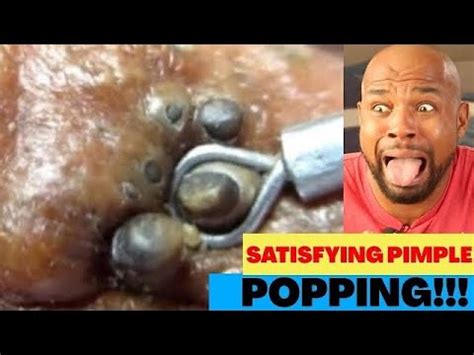 Why Pimple Popping Videos Are So Satisfying