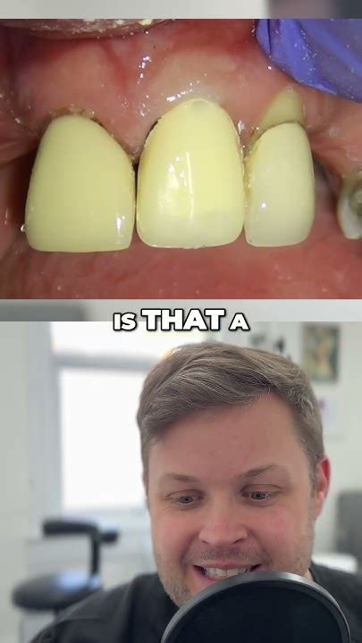 Why Temporary Crowns Matter