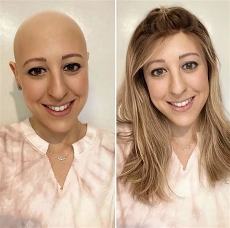 Wigs for Cancer Patients: A Lifeline of Comfort and Confidence