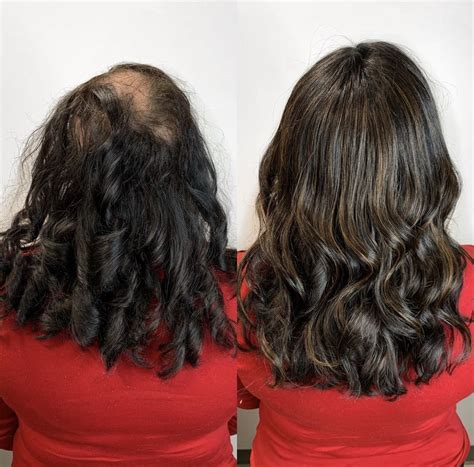 Wigs for Hair Loss: A Complete Solution to Enhance Confidence