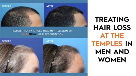 Women Thinning Hair Temples Extension: 10,000+ Word Guide to Regrowth and Hairline Restoration