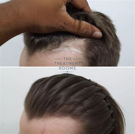 Women Thinning Hair Temples Extension: A Therapeutic Solution for Hair Loss