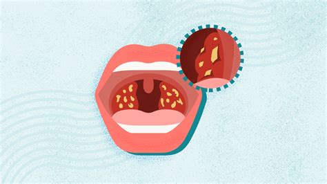 Your Throat: A Gateway to Health and Well-being