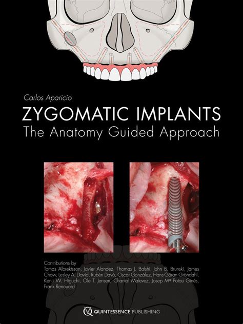 Zygomatic Implants: The Anatomy Guided Approach Ebook Reader