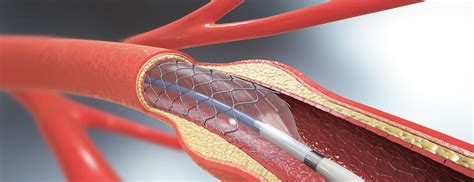 a guide to coronary angioplasty and stenting Reader