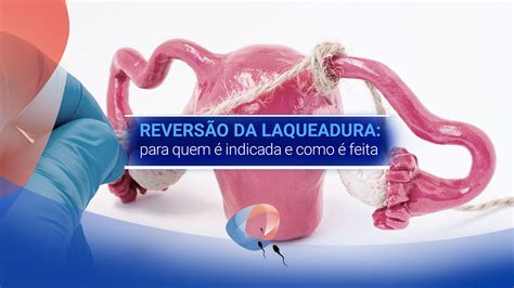 a laqueadura tem reversão