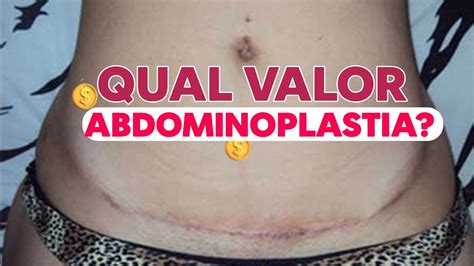 abdominoplastia valor 2024