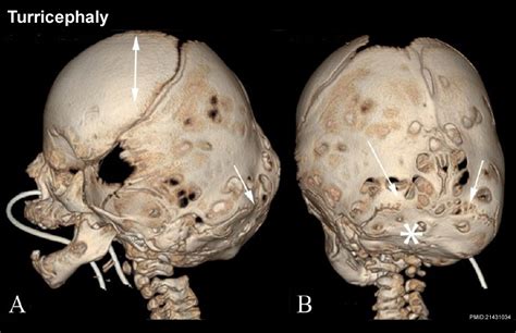 abnormal skeletal phenotypes abnormal skeletal phenotypes Doc