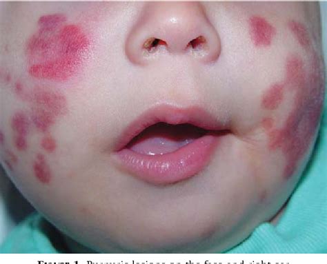 acute hemorrhagic edema of infancy