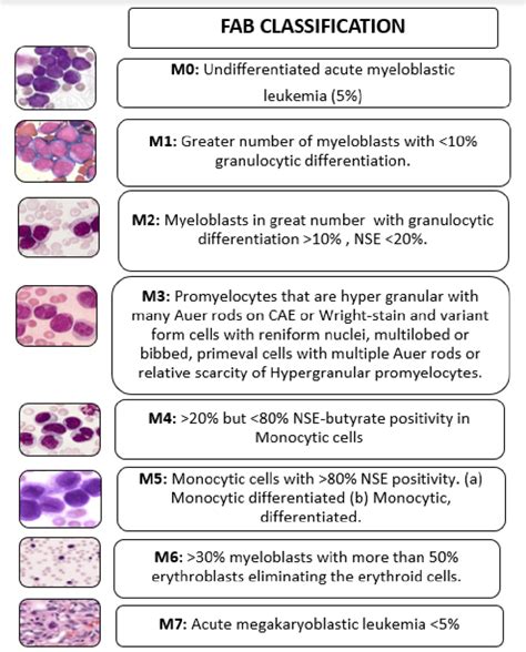 acute myeloid leukemia classification treatment Epub