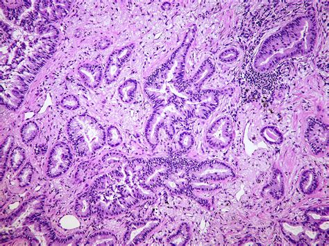 adenocarcinoma acinar usual