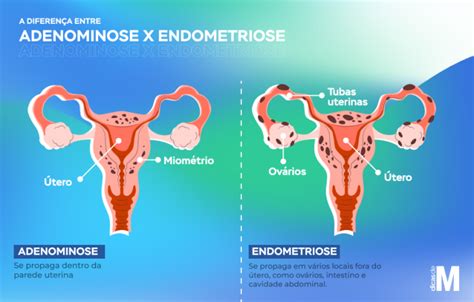 adenomiose focal