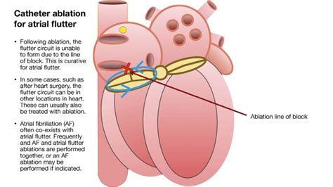aflutter ablation manual guide Reader