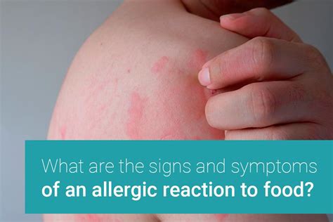 allergic reaction to food symptoms