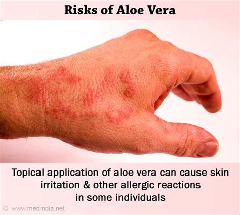 aloe allergy