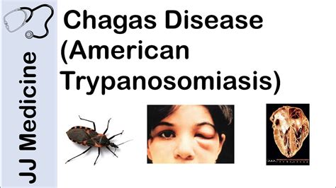 american trypanosomiasis american trypanosomiasis PDF