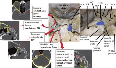 anatomy and surgery of the cavernous sinus Epub